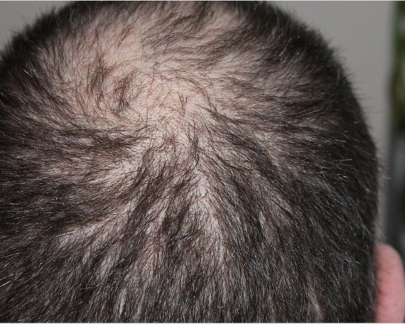 hair loss